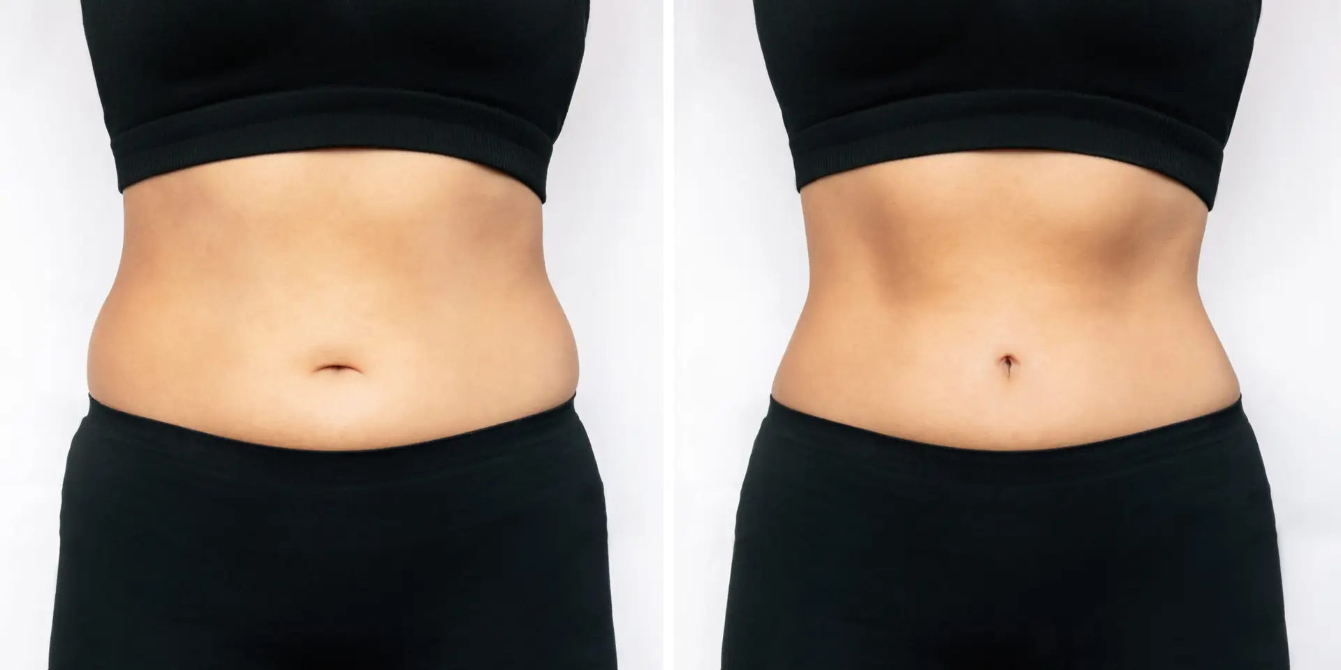 Liposuction Surgery in Istanbul
