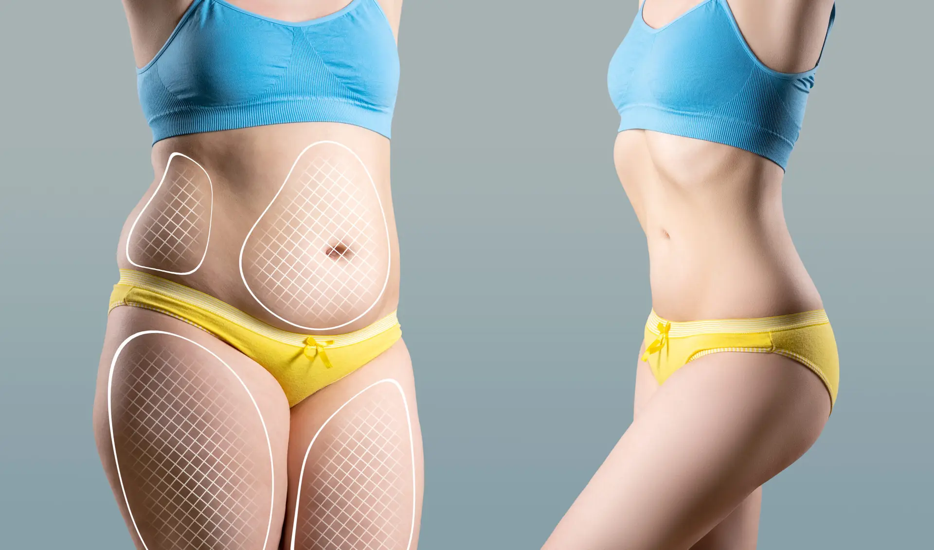 Liposculpture in San Jose