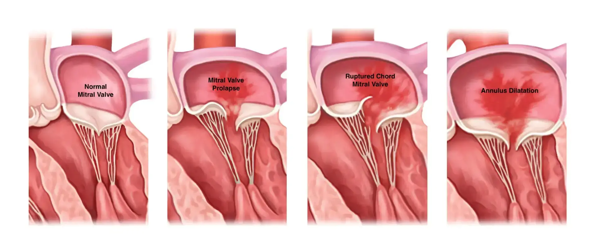Heart Valve Disease Treatment in Panama