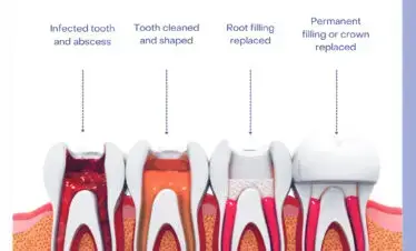 image explaining root canal procedure