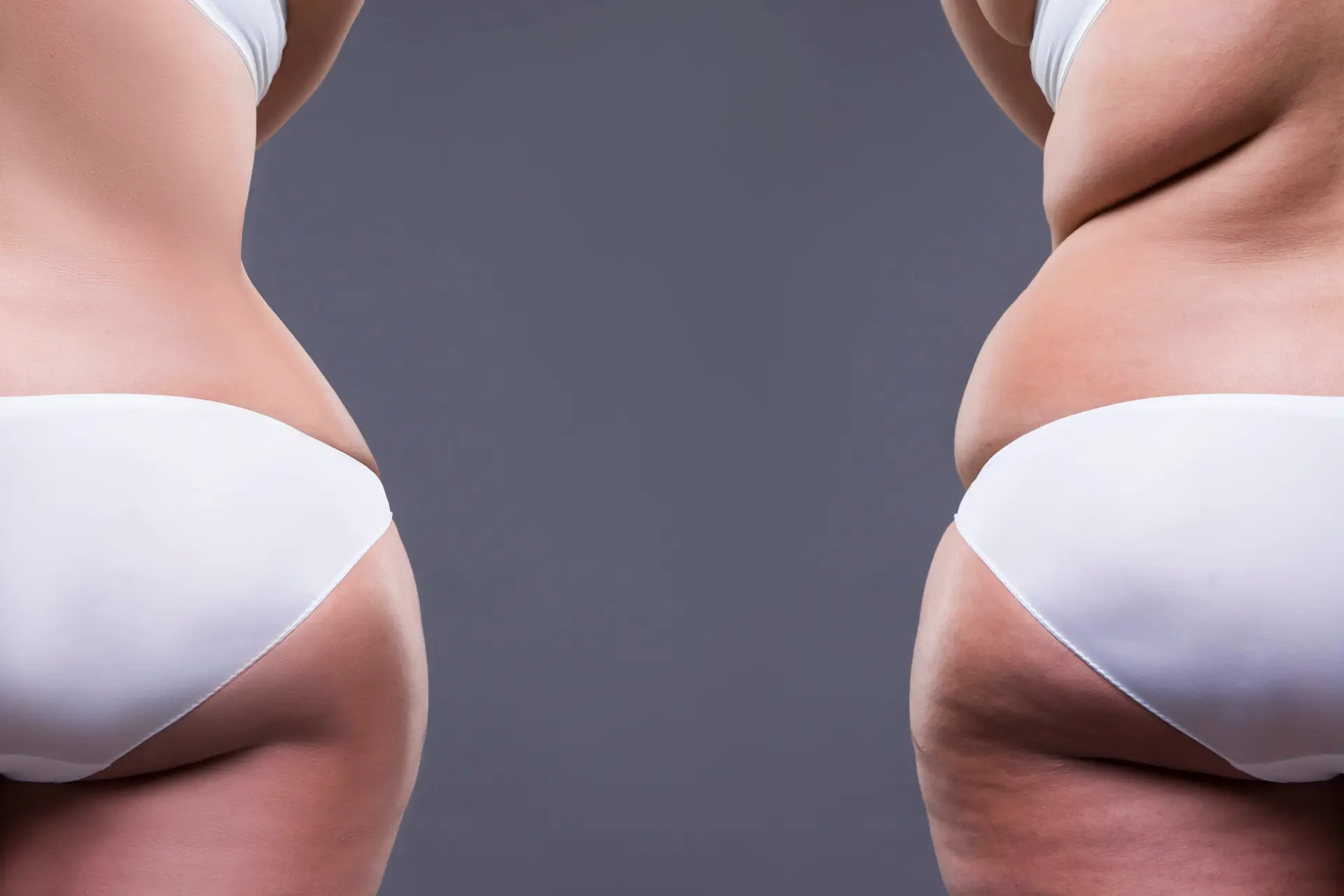 Liposculpture in San Jose