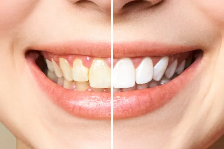 Dental Veneers in Bogota, Colombia by Malo Dental
