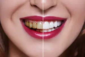 Dental Veneer Clinics and Procedures Abroad