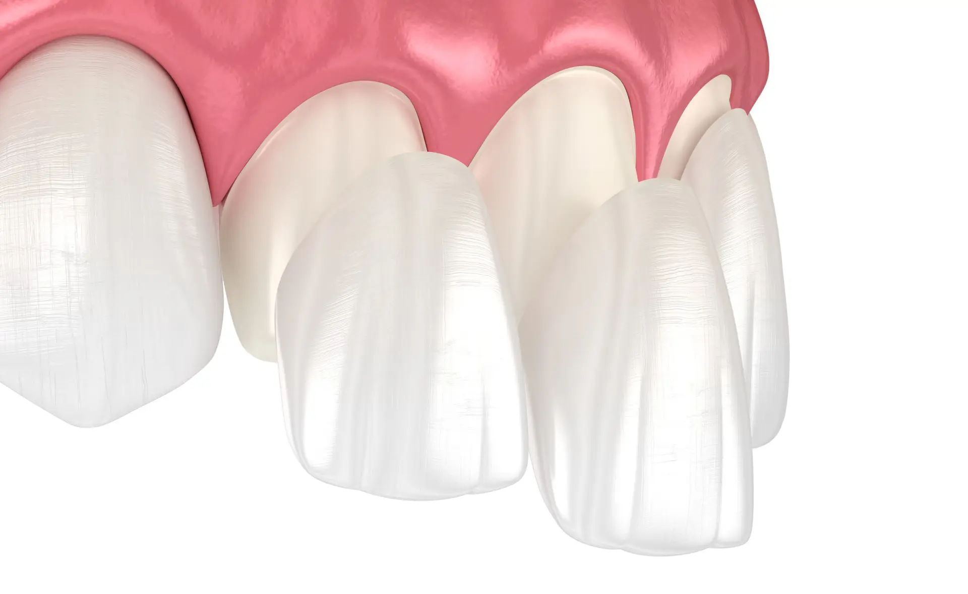 Dental Veneers in Sao Paulo