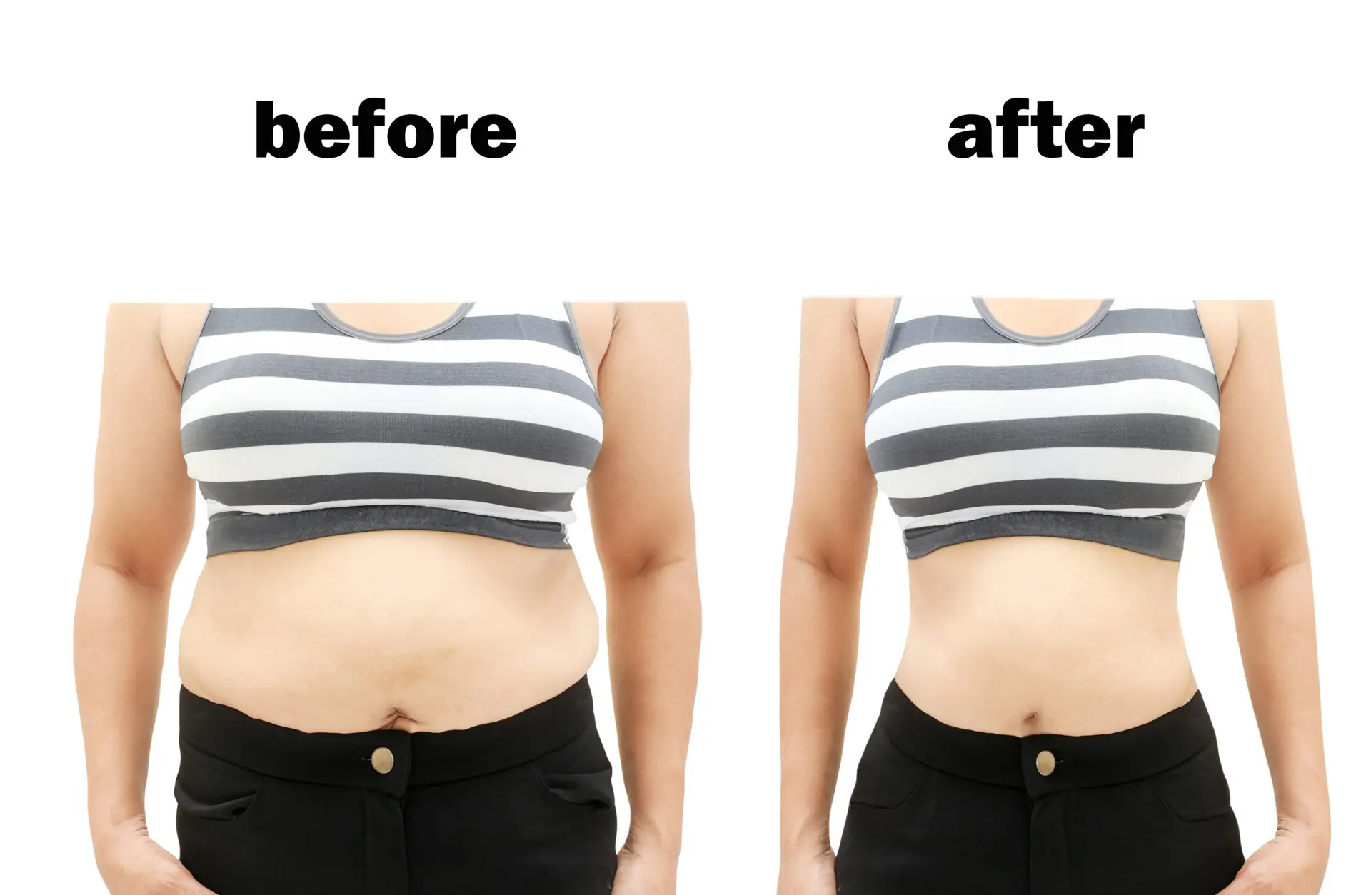 Bariatric Surgery in Dubai — Procedure Gallery Photo