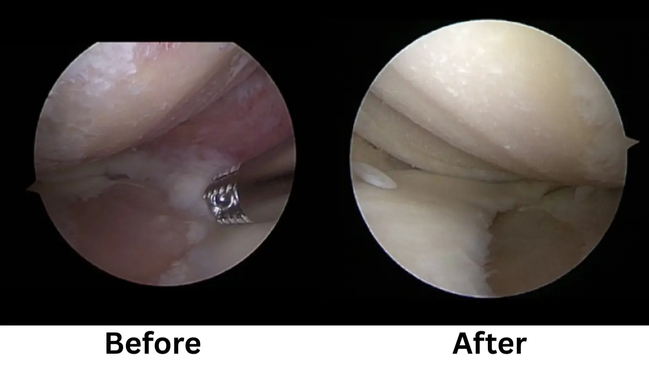 Knee Osteoarthritis Treatment using Stem Cell Surgery in Seoul, South Korea by Gangnam JS Hospital