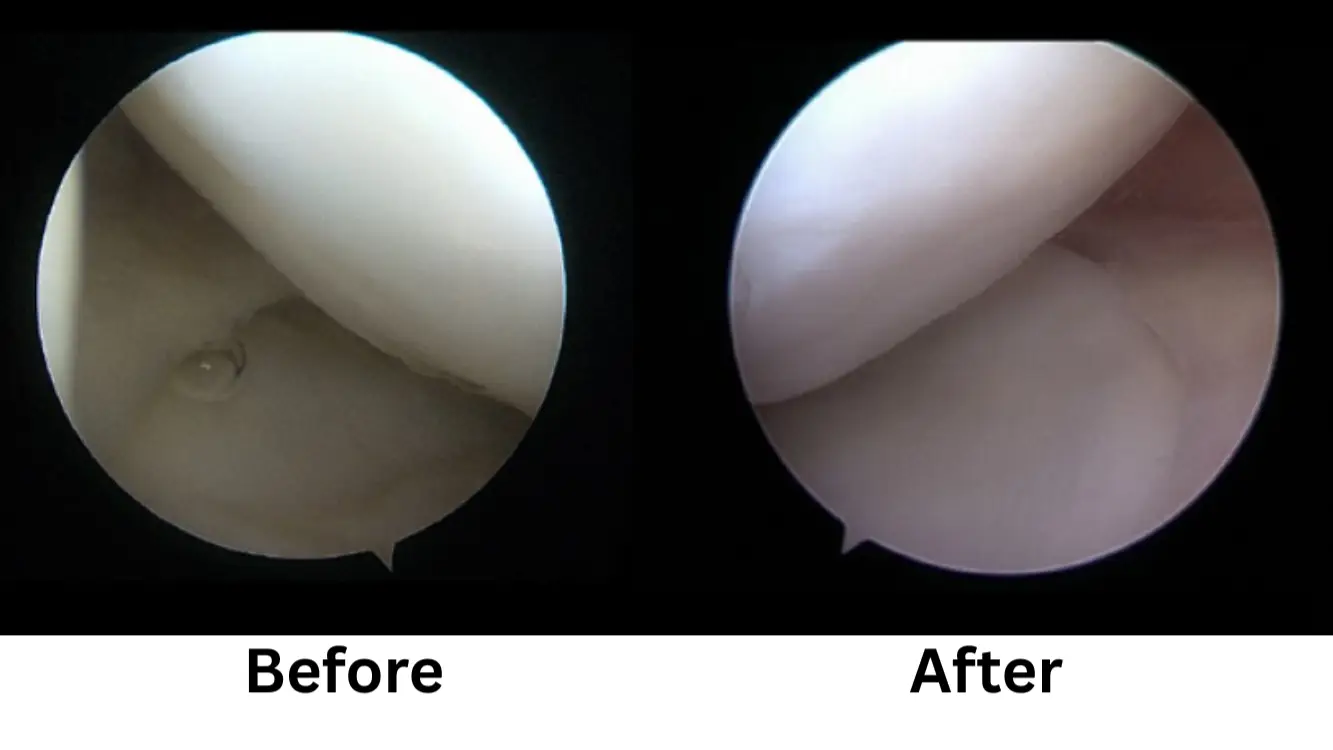 Knee Osteoarthritis Treatment using Stem Cell Surgery in Seoul, South Korea by Gangnam JS Hospital