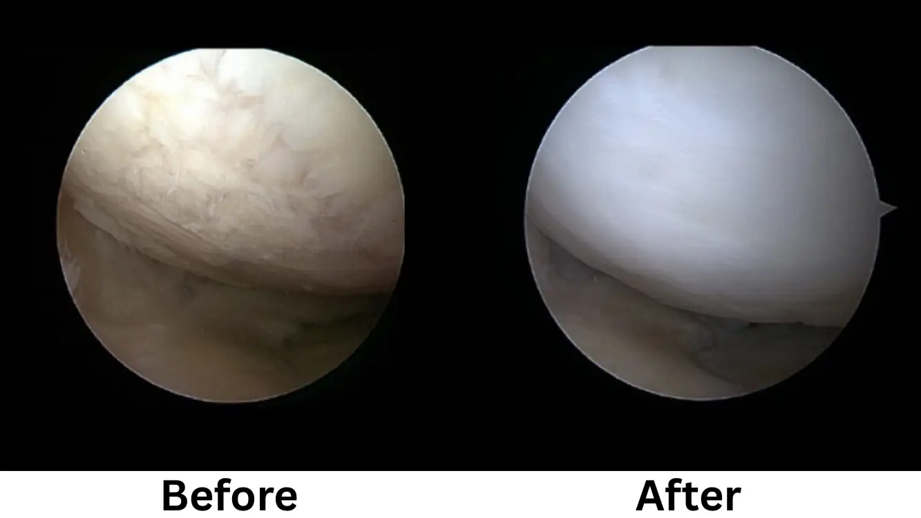 Knee Osteoarthritis Treatment using Stem Cell Surgery in Seoul, South Korea by Gangnam JS Hospital