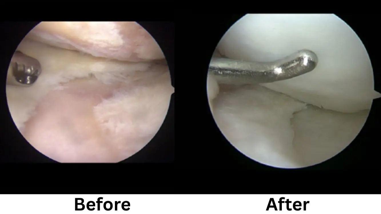 Knee Osteoarthritis Treatment using Stem Cell Surgery in Seoul, South Korea by Gangnam JS Hospital