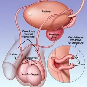 Vasectomy Reversal Clinics and Procedures Abroad