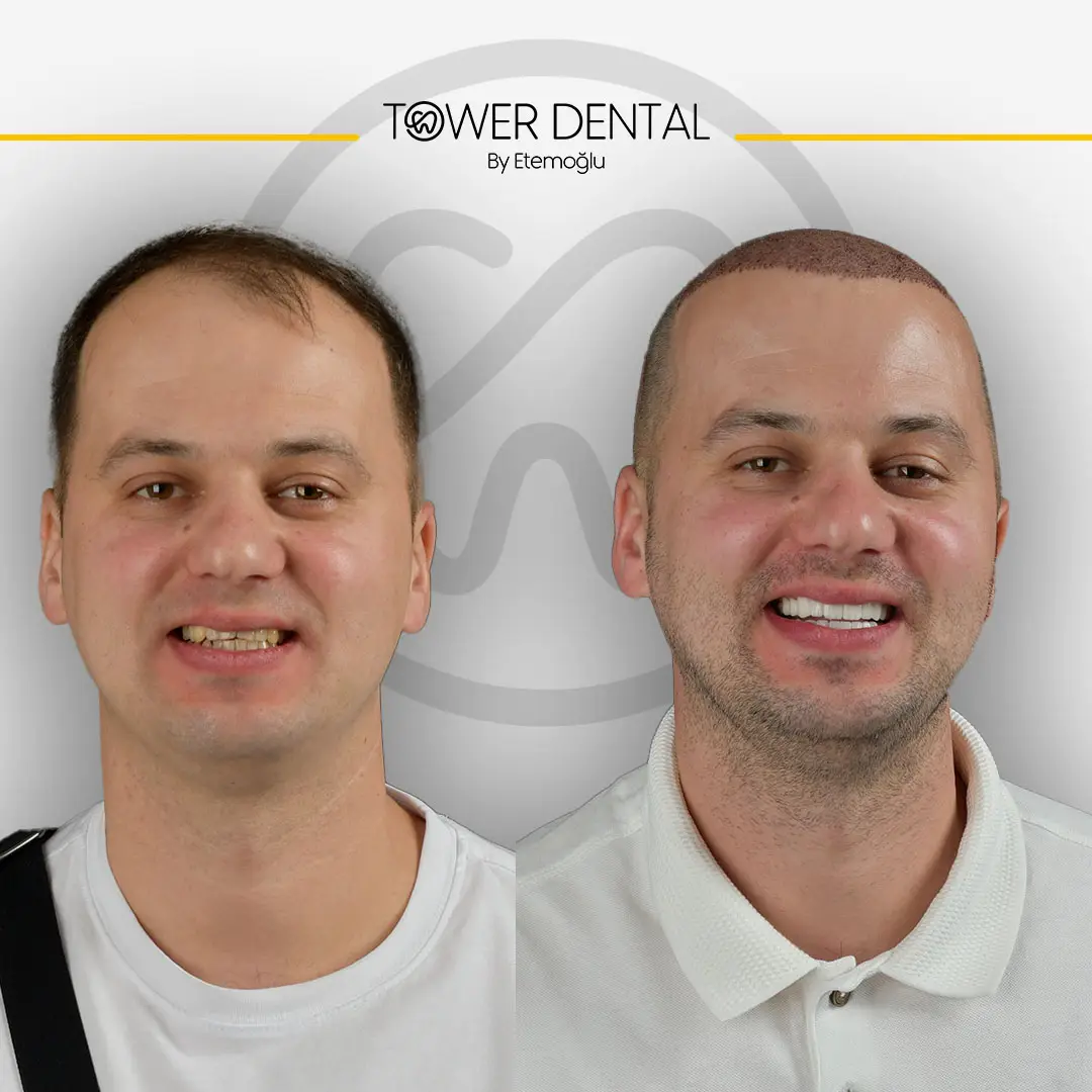 Dental Crown in Istanbul, Turkey by Tower Dental Clinic