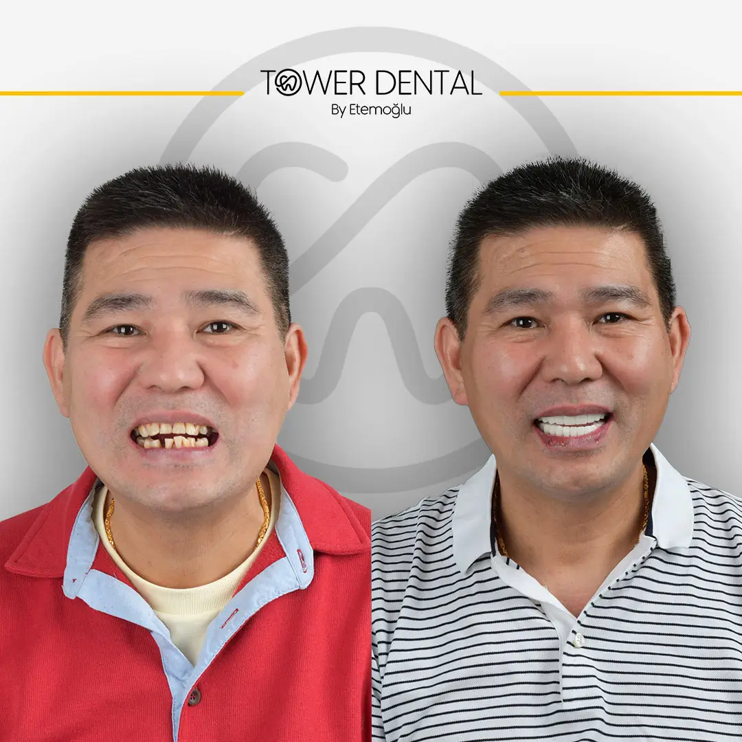 Dental Crown in Istanbul, Turkey by Tower Dental Clinic