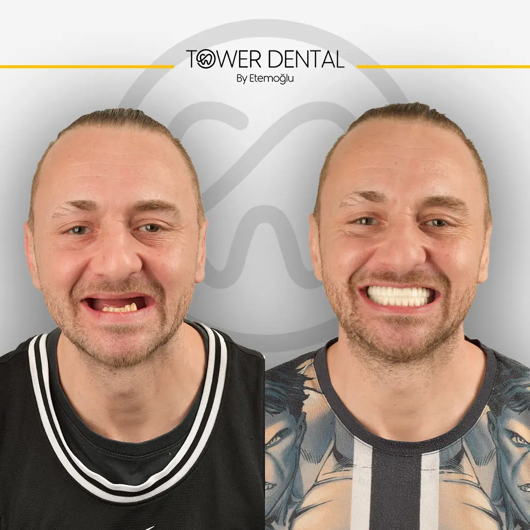 Dental Crown in Istanbul, Turkey by Tower Dental Clinic