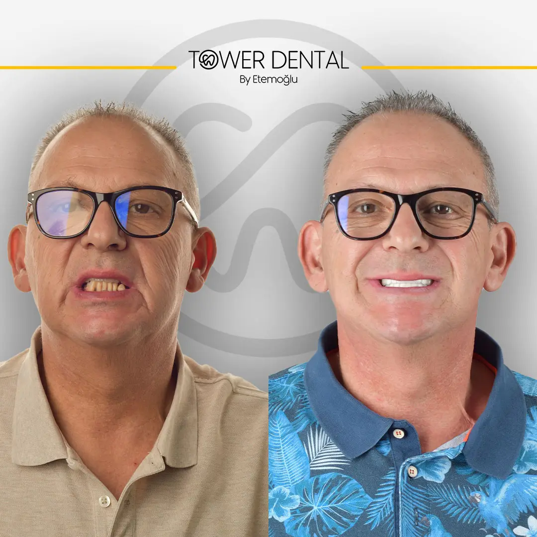 Dental Crown in Istanbul, Turkey by Tower Dental Clinic
