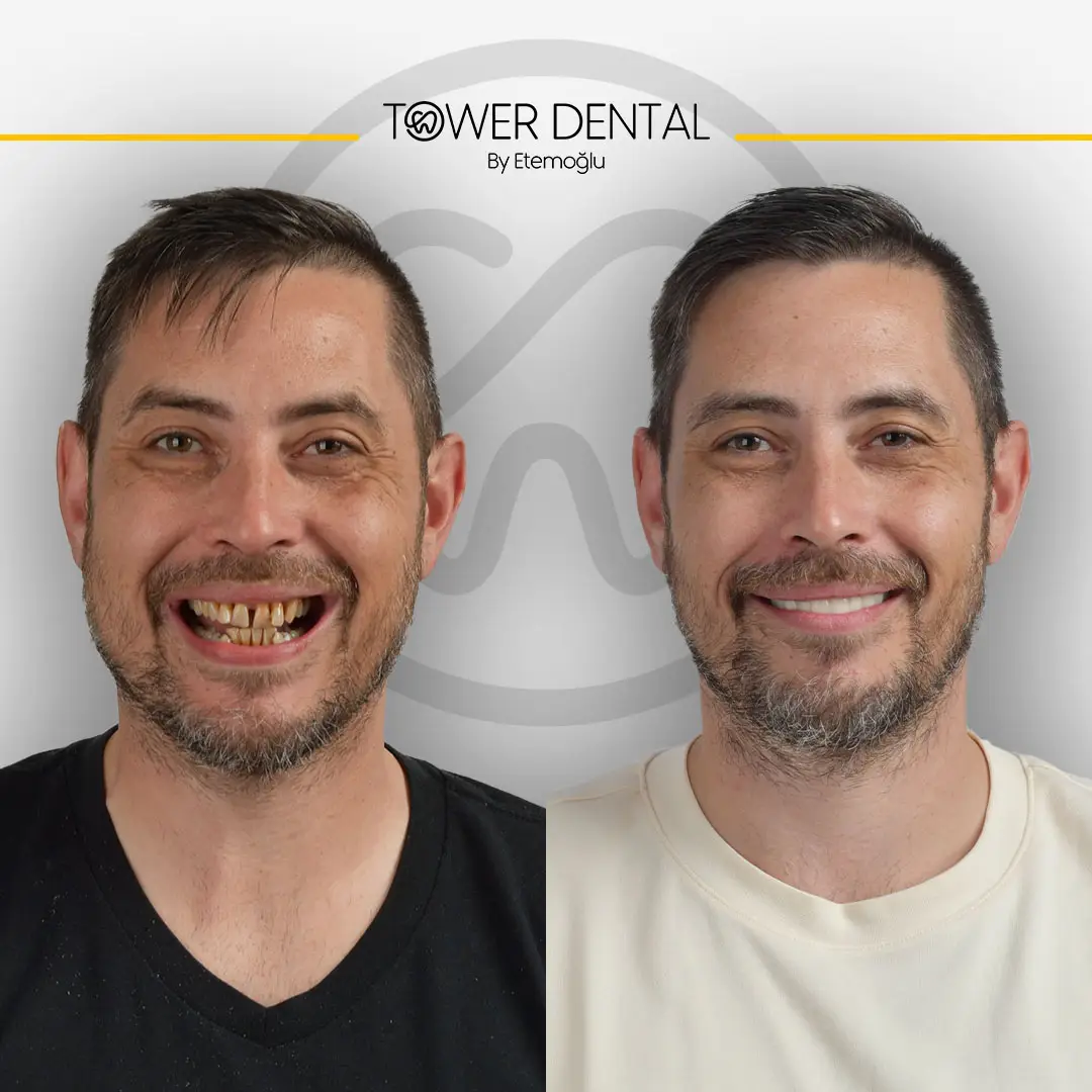 Dental Crown in Istanbul, Turkey by Tower Dental Clinic