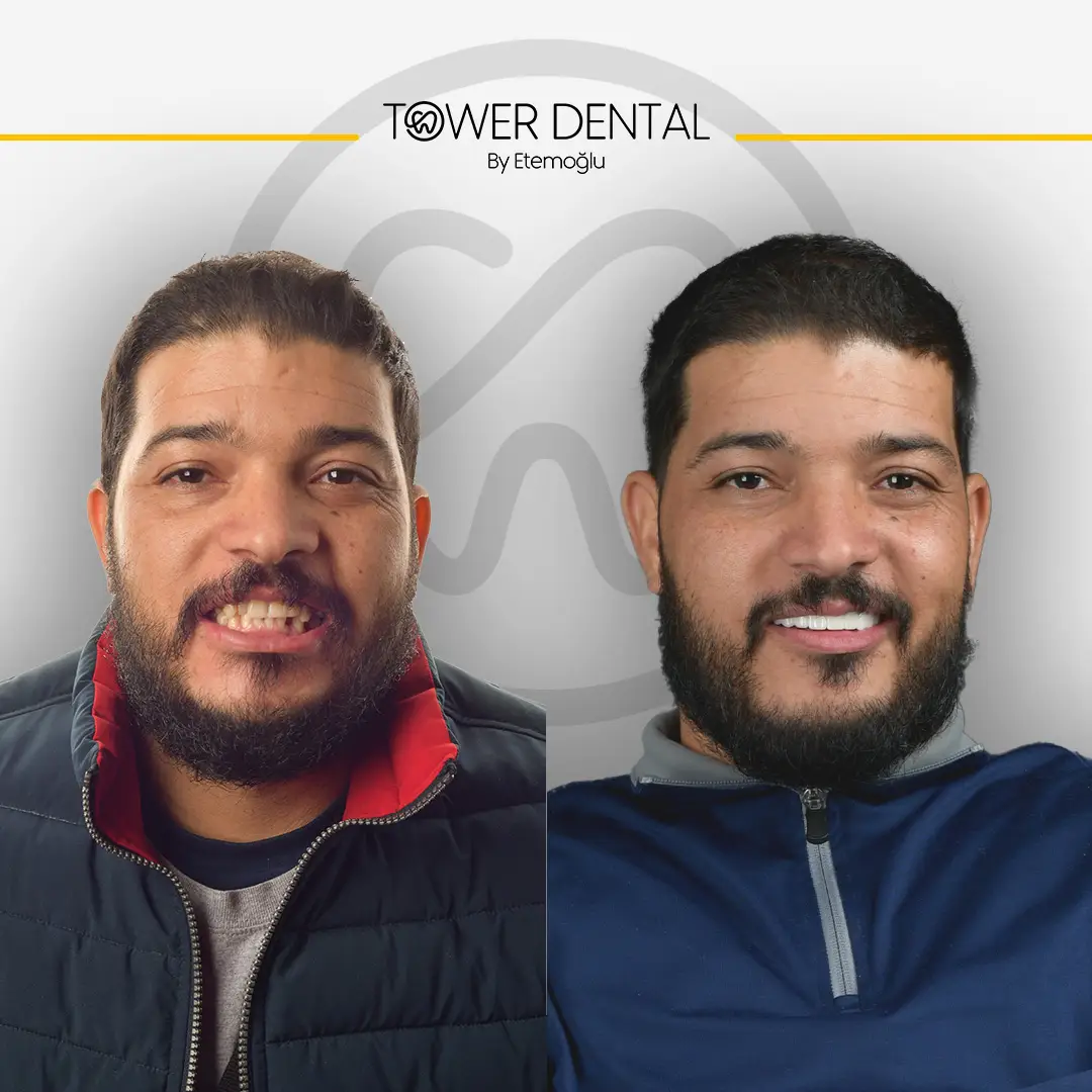 Dental Crown in Istanbul, Turkey by Tower Dental Clinic
