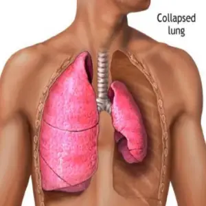 Thoracic Surgery Clinics and Procedures Abroad
