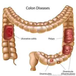 Colon Surgery Clinics and Procedures Abroad
