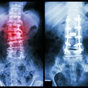 Spine Surgery Clinics and Procedures Abroad