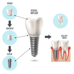 Dental Implant Clinics and Procedures Abroad