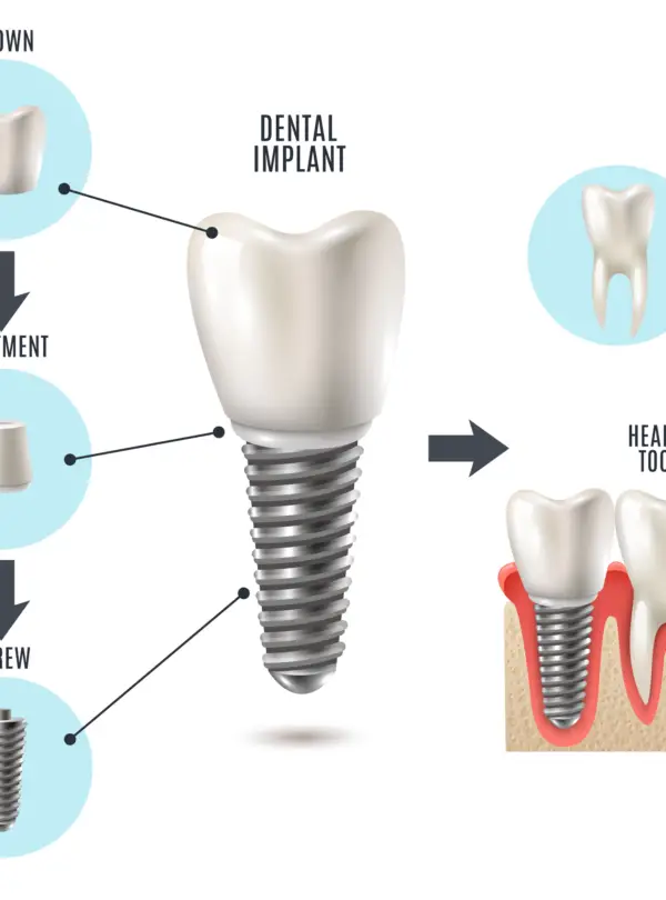 implant square