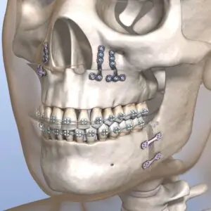 Maxillofacial Surgery Clinics and Procedures Abroad