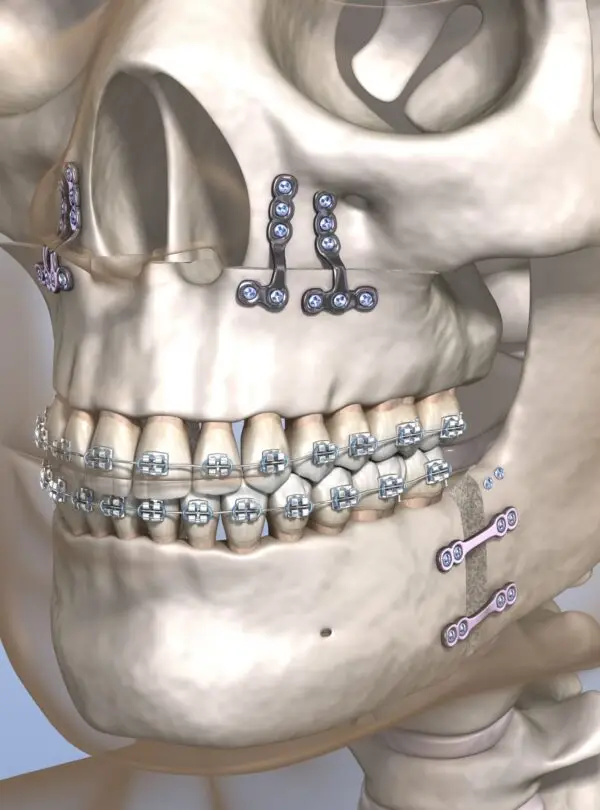 maxillary square