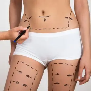 Liposculpture Clinics and Procedures Abroad