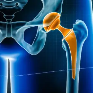 Hip Surgery Clinics and Procedures Abroad