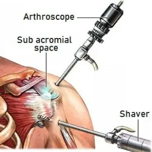 Shoulder & Elbow Surgery Clinics and Procedures Abroad