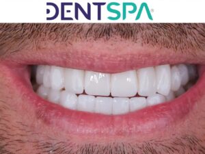 Premium Prosthesis in Istanbul, Turkey by DentSpa — Dentistry in Turkey
