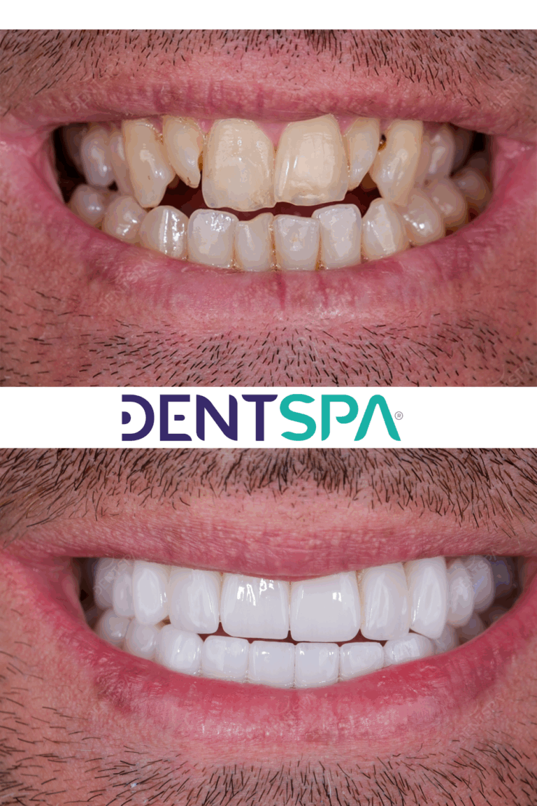 Premium Prosthesis in Istanbul, Turkey by DentSpa