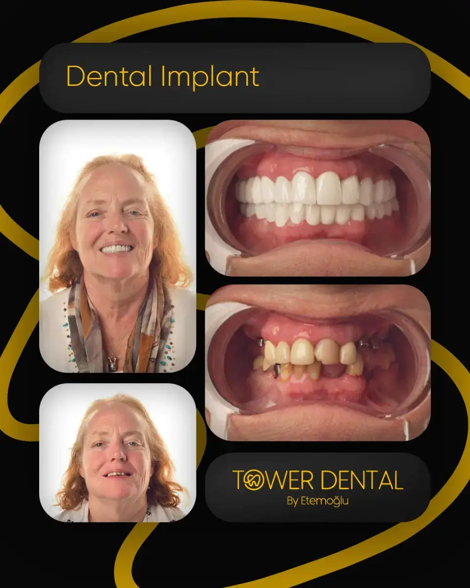 Dental Implant in Istanbul, Turkey by Tower Dental Clinic
