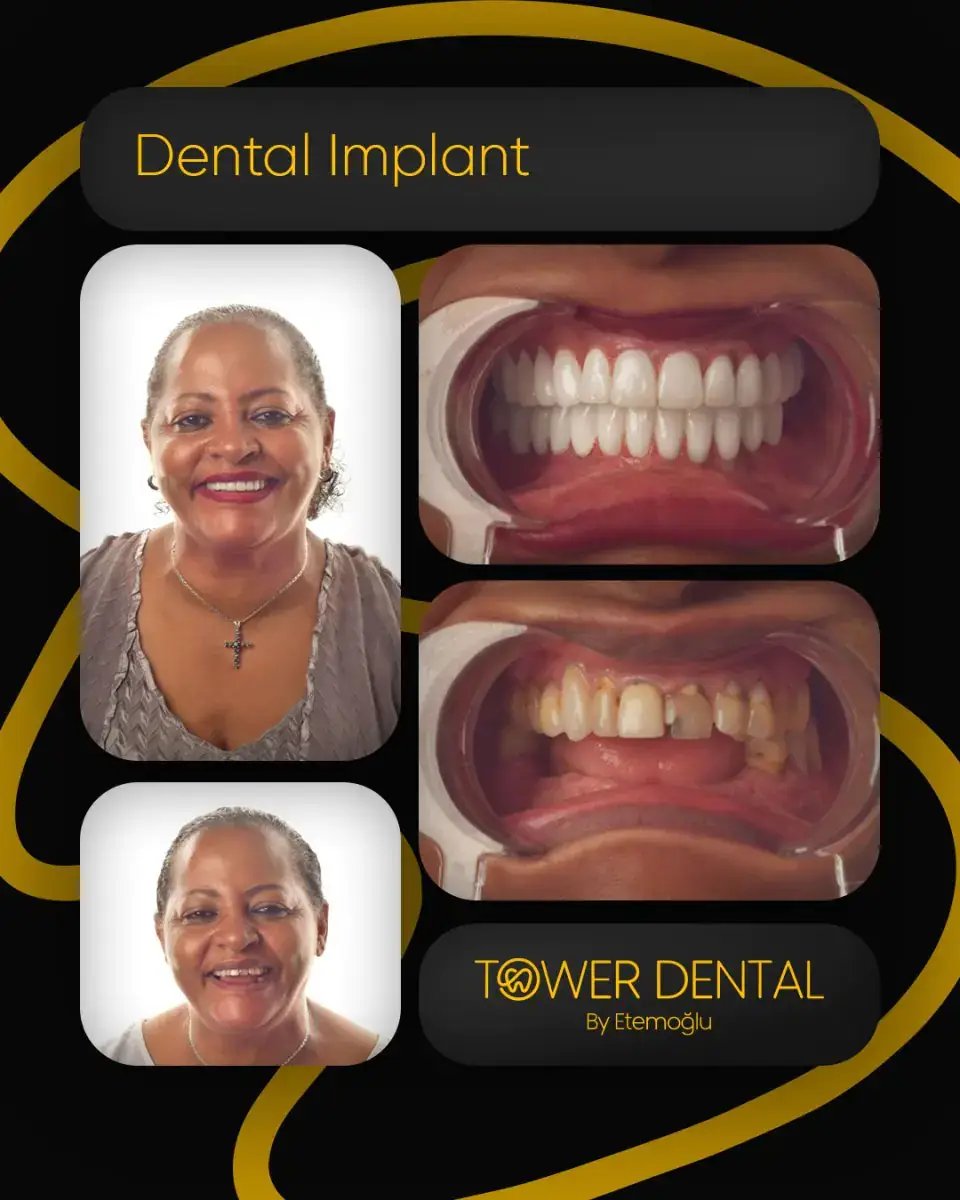 Dental Implant in Istanbul, Turkey by Tower Dental Clinic