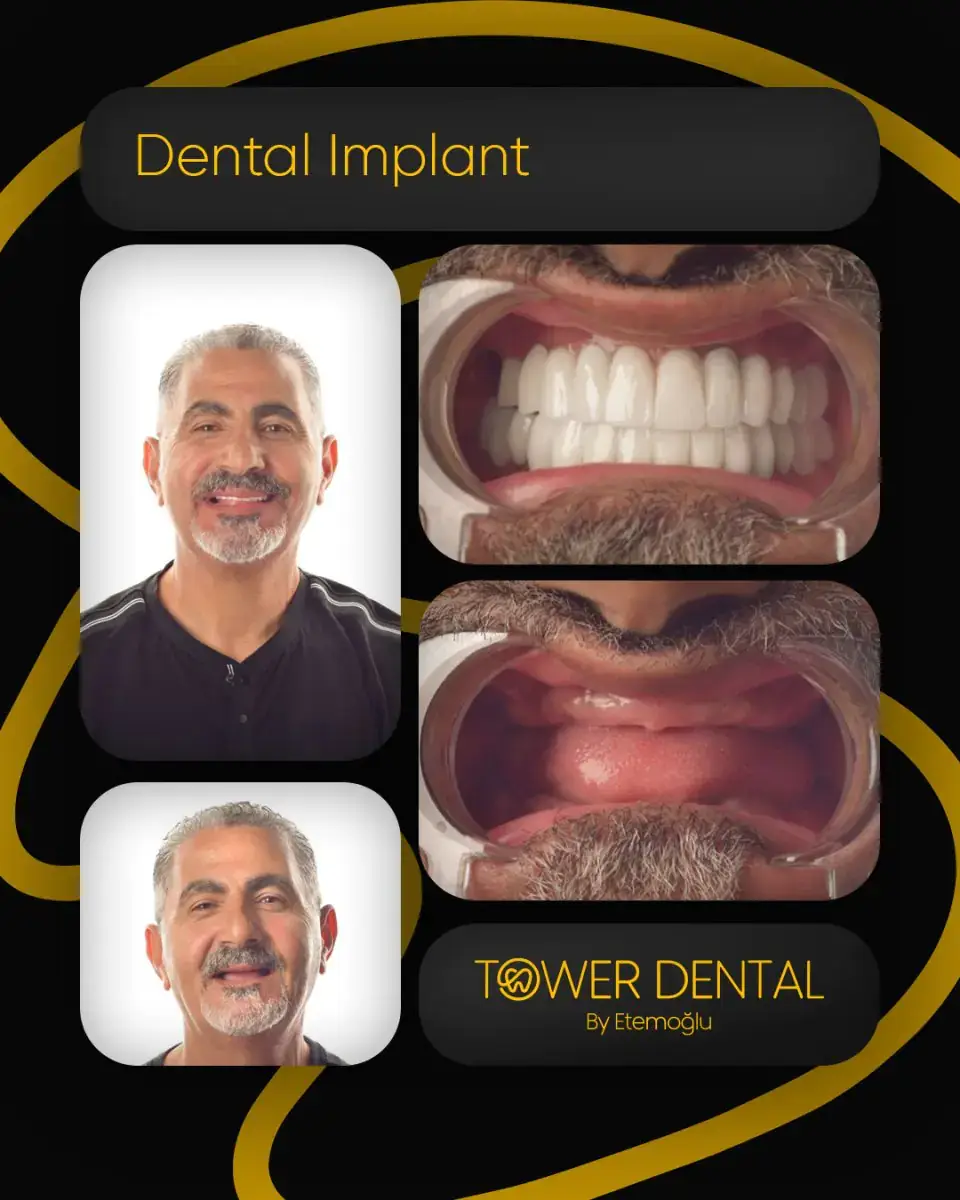 Dental Implant in Istanbul, Turkey by Tower Dental Clinic