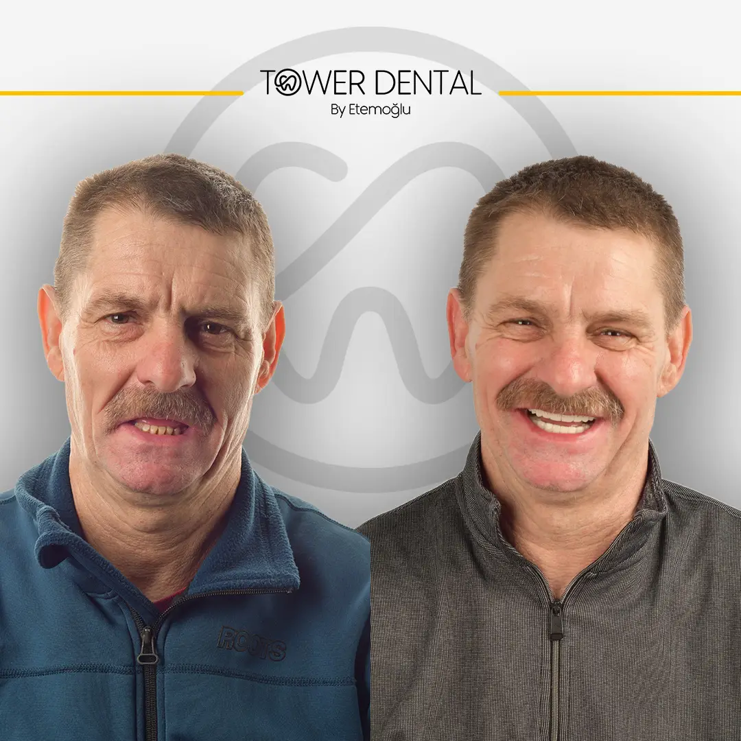 Denture (Per Arch) in Istanbul, Turkey by Tower Dental Clinic