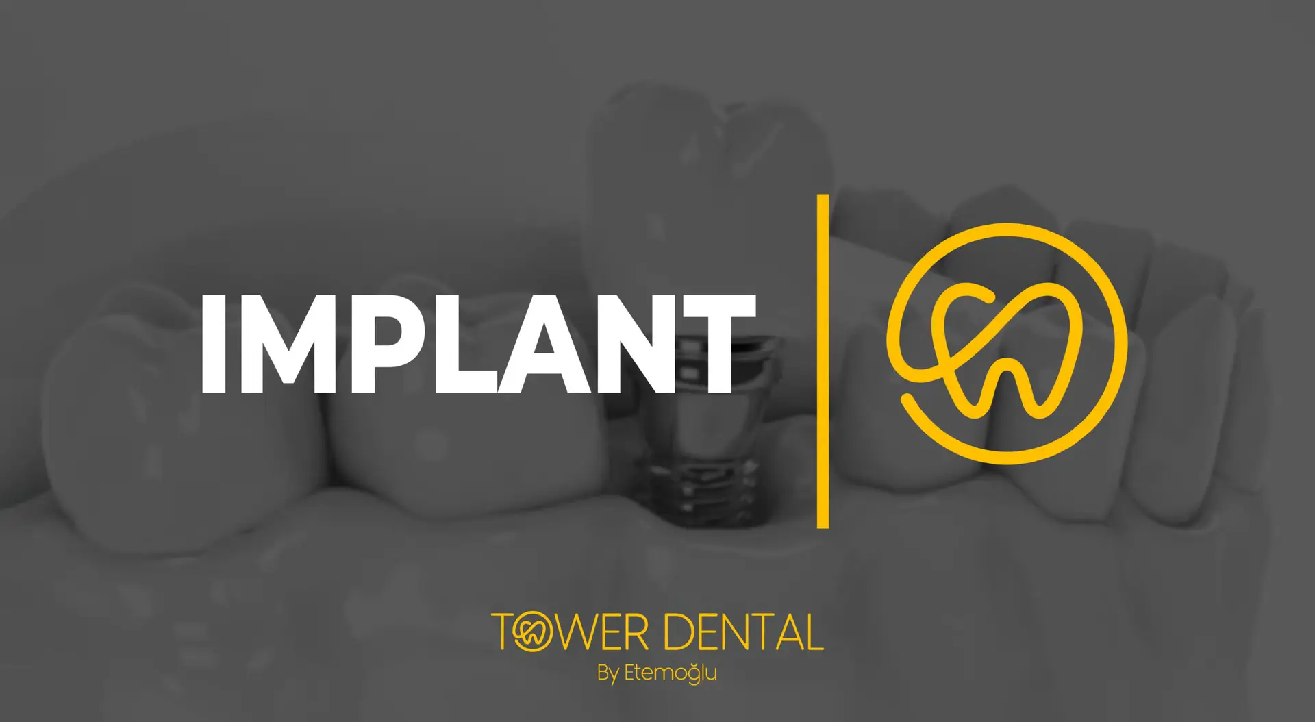 Dental Implant in Istanbul, Turkey by Tower Dental Clinic