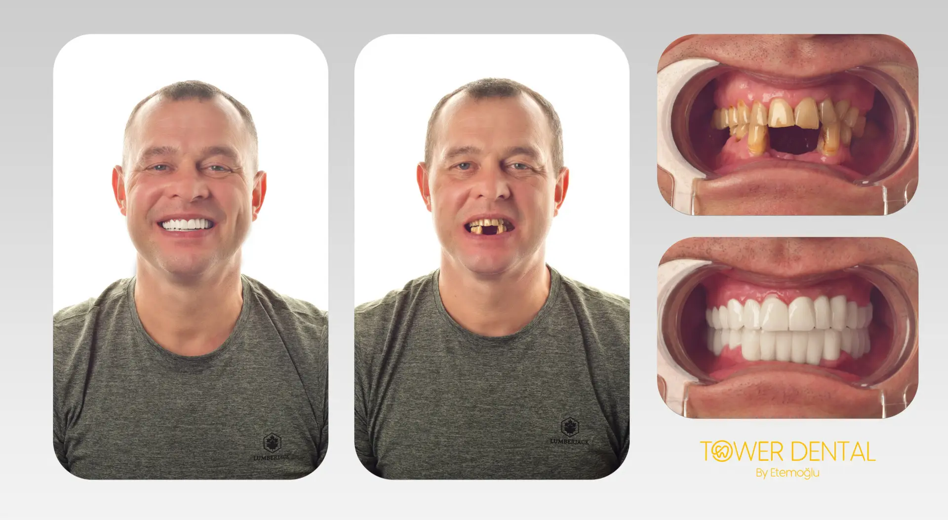 Dental Implant in Istanbul, Turkey by Tower Dental Clinic
