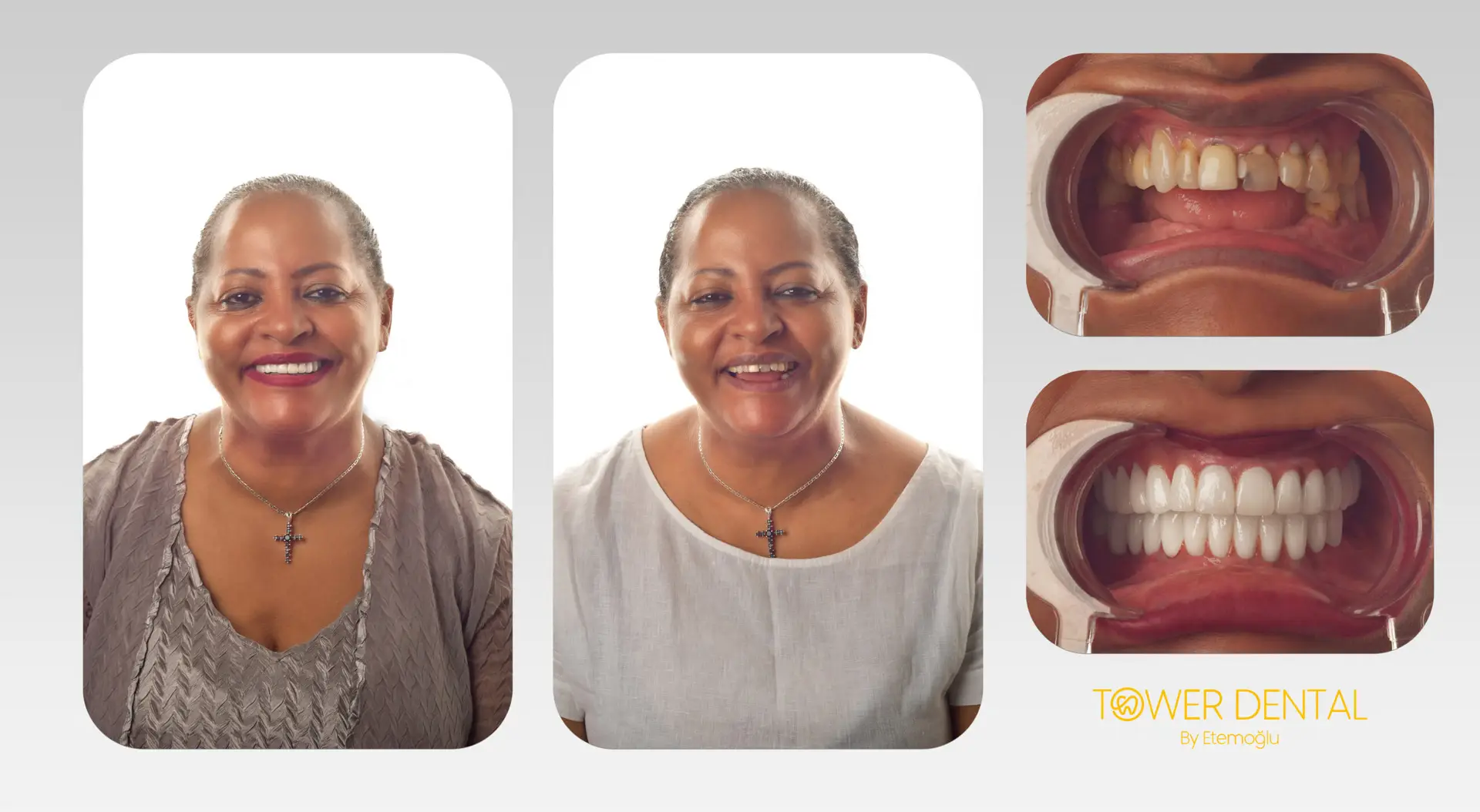 Dental Implant in Istanbul, Turkey by Tower Dental Clinic