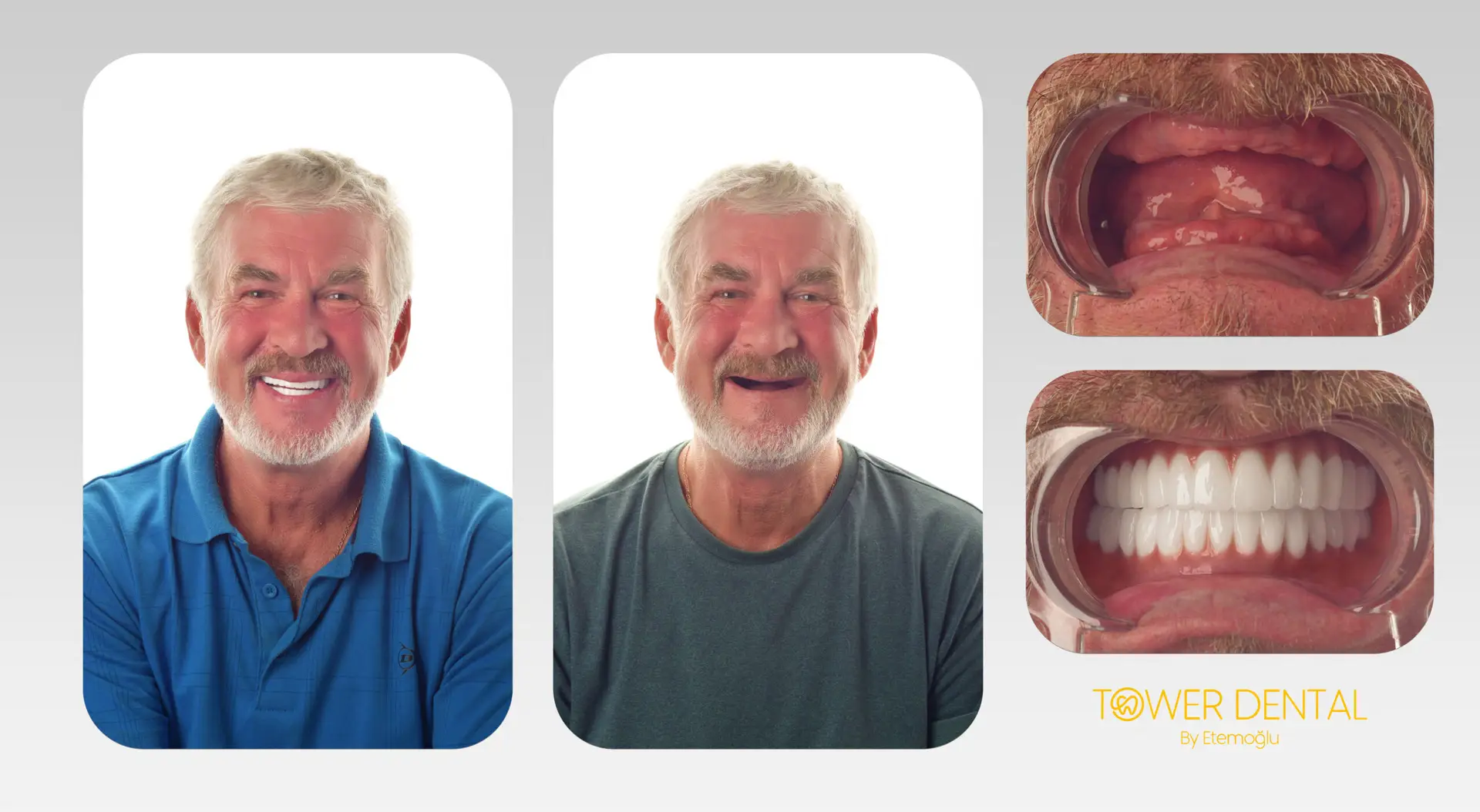 Dental Implant in Istanbul, Turkey by Tower Dental Clinic