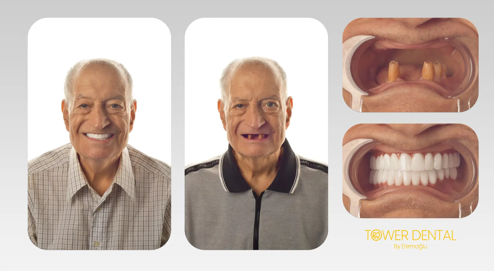 Dental Implant in Istanbul, Turkey by Tower Dental Clinic