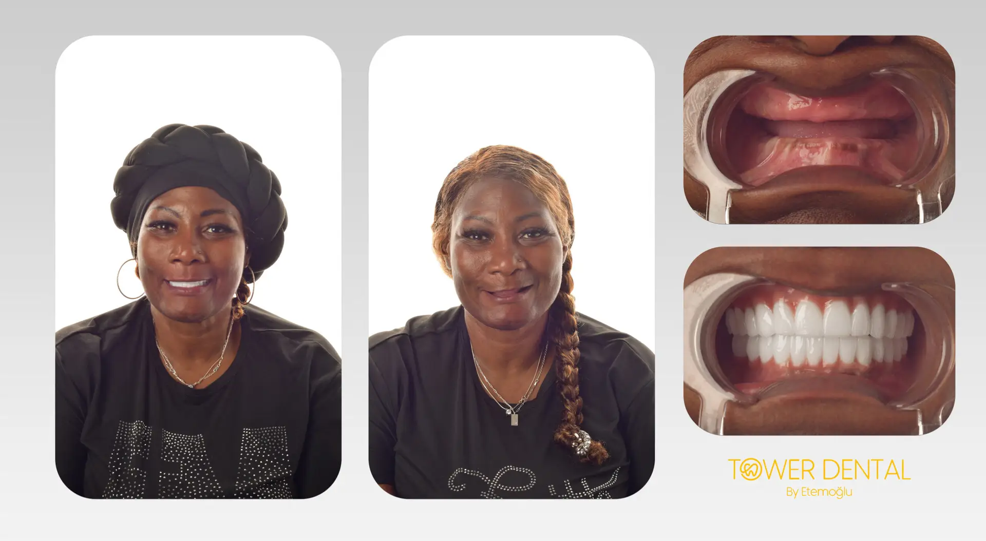 Dental Implant in Istanbul, Turkey by Tower Dental Clinic