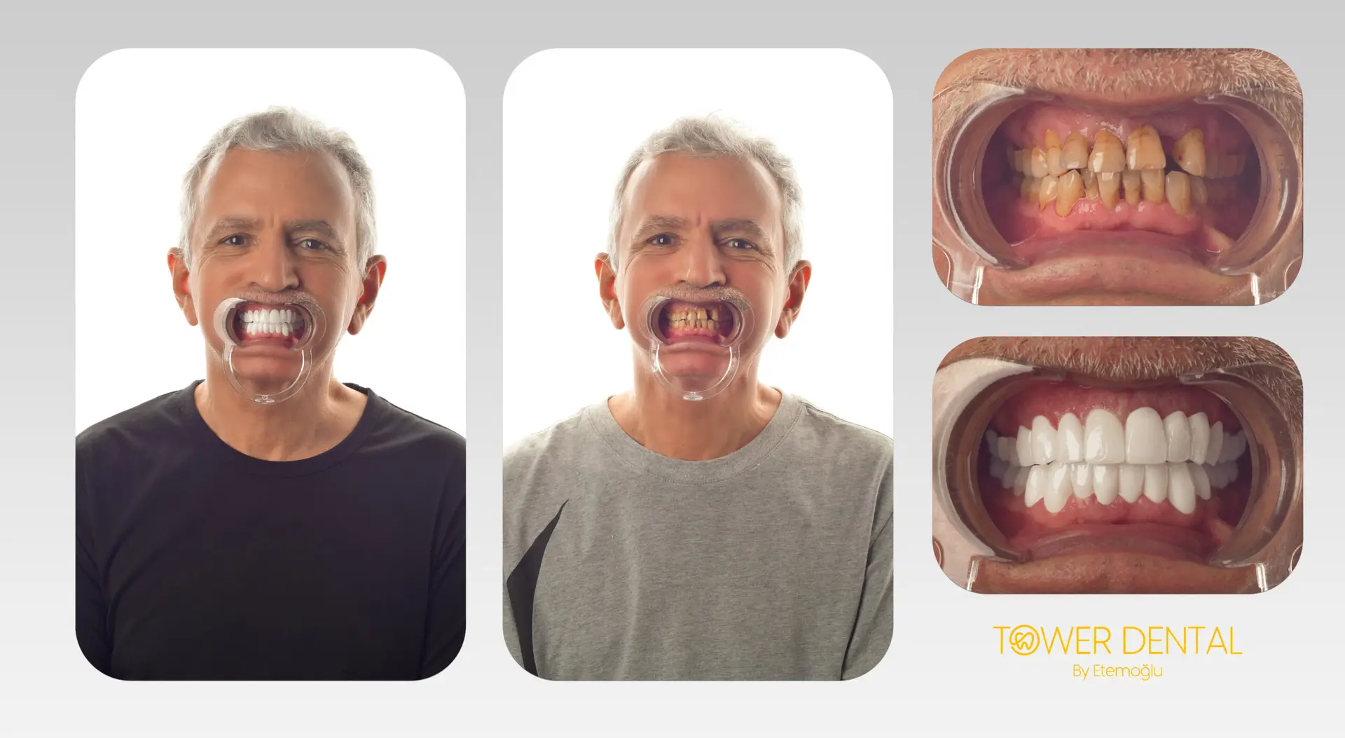 Dental Implant in Istanbul, Turkey by Tower Dental Clinic