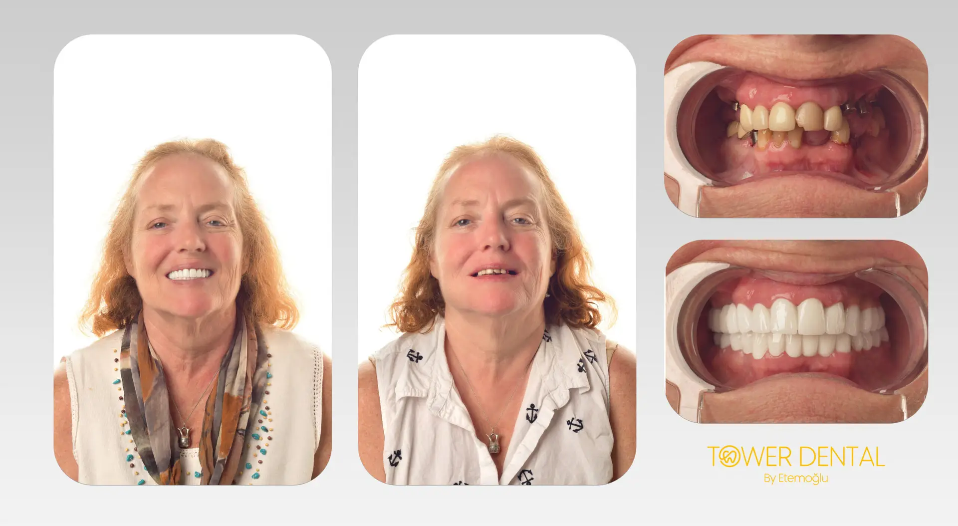 Dental Implant in Istanbul, Turkey by Tower Dental Clinic