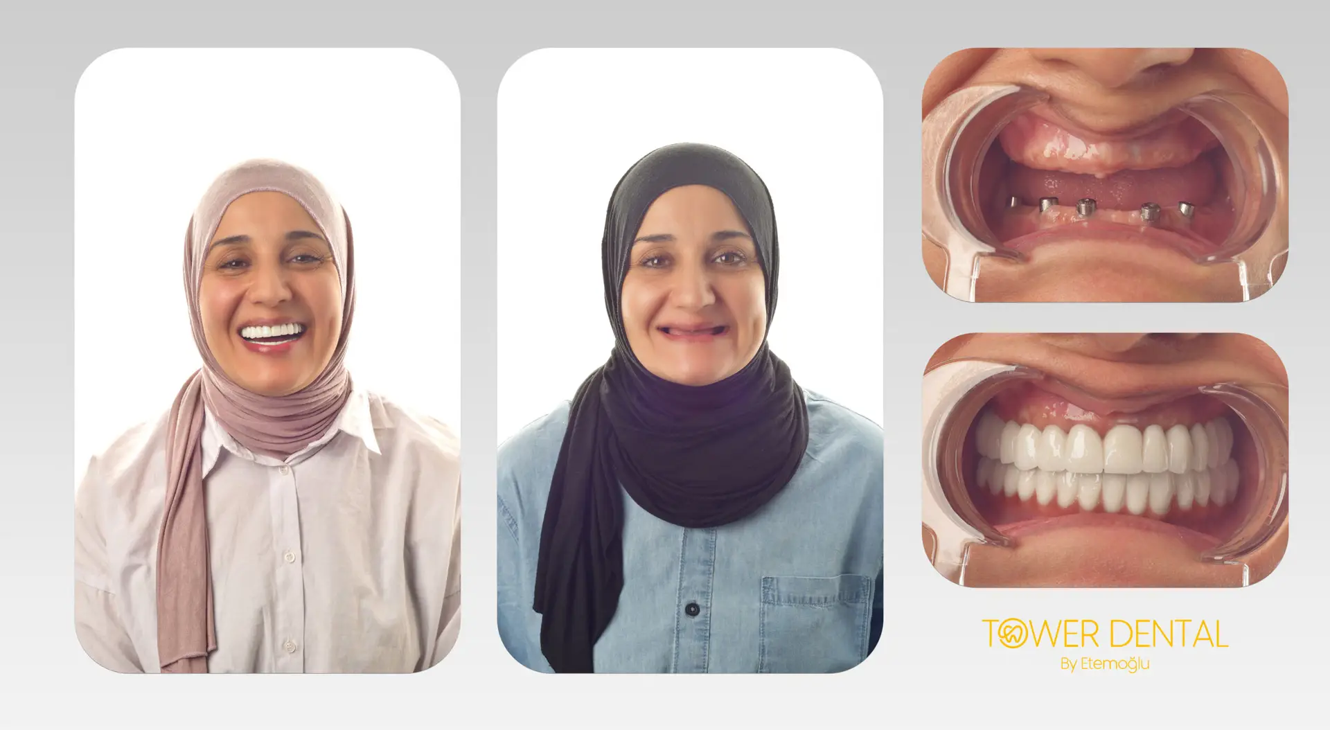 All-on-4/6 Full-Mouth Prosthesis (12–14 Crowns per Arch) in Istanbul, Turkey by Tower Dental Clinic