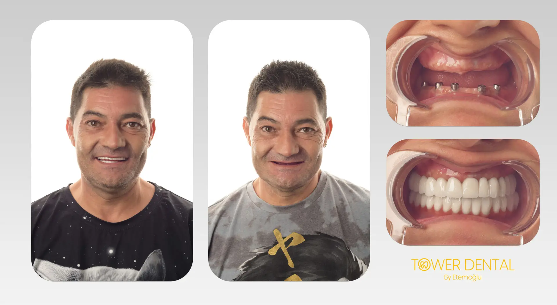 All-on-4/6 Full-Mouth Prosthesis (12–14 Crowns per Arch) in Istanbul, Turkey by Tower Dental Clinic