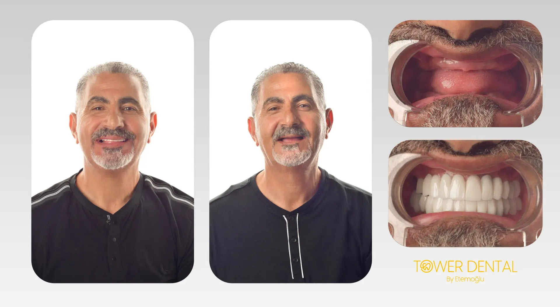 Dental Implant in Istanbul, Turkey by Tower Dental Clinic