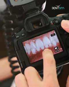 Premium Dentures in Istanbul, Turkey by DentSpa