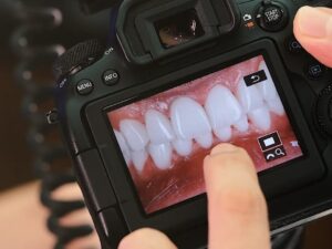Premium Dentures in Istanbul, Turkey by DentSpa — Dentistry in Turkey
