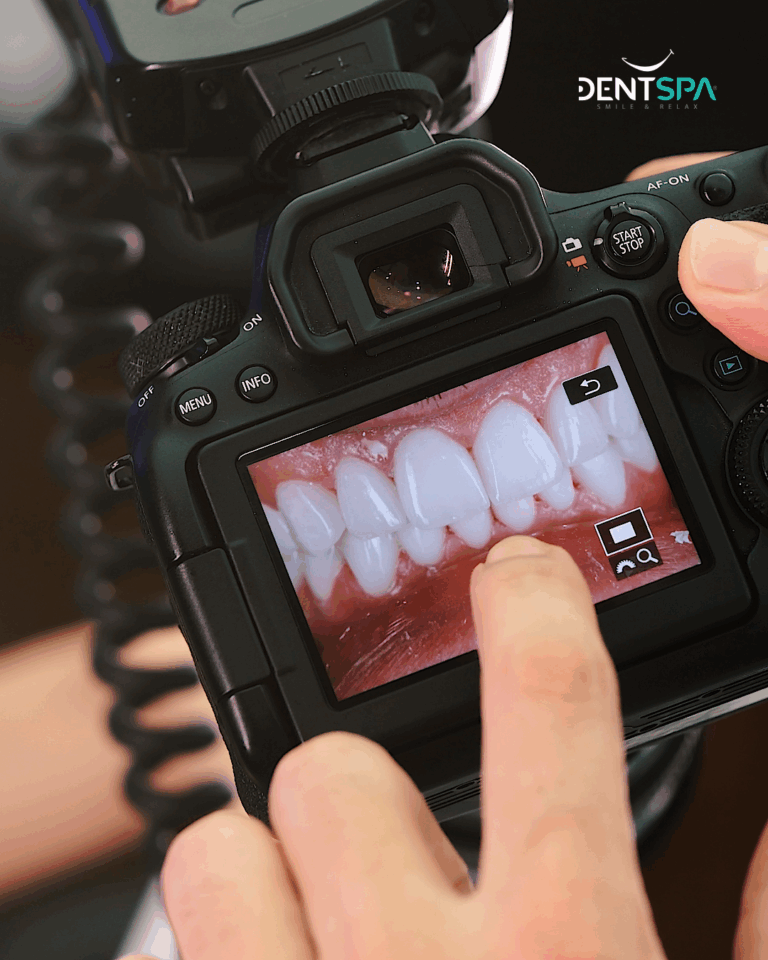 Premium Dentures in Istanbul, Turkey by DentSpa